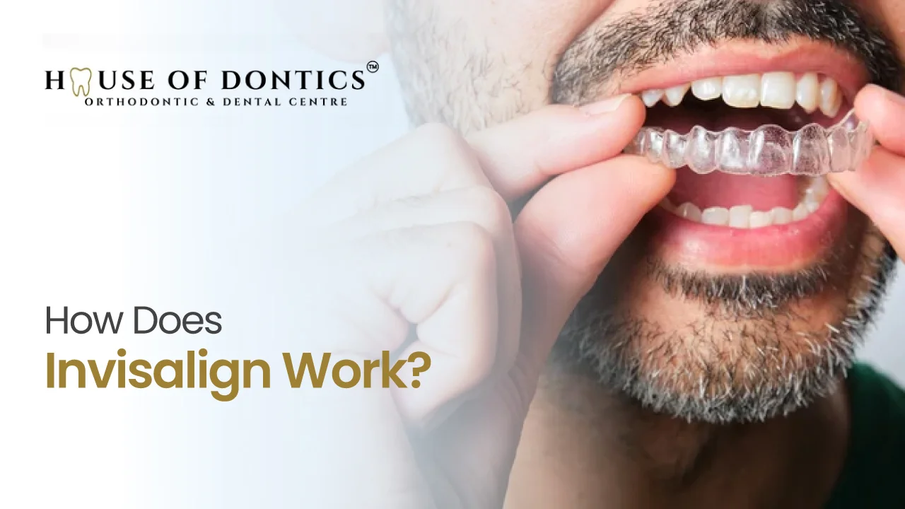 How Does Invisalign work
