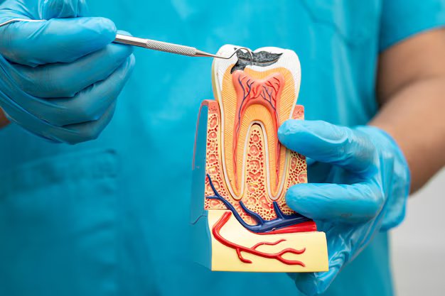 Why Root Canal overview