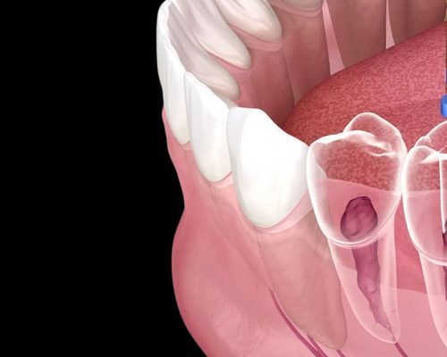  Getting Ready for Your First Root Canal Treatment - The Need-to-Know Details