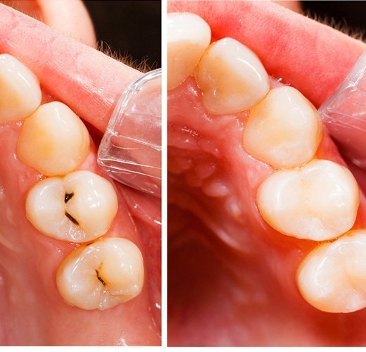 Cosmetic-Tooth-Colored-Fillings-in-gujarat