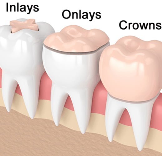 Inlays-&-Onlays-in-gujarat