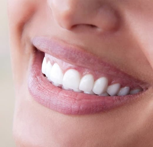 Jetting-Out-Teeth-Correction-treatment-in-ahmedabad