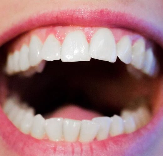 Mottling-of-Teeth-Correction-in-ahmedabad