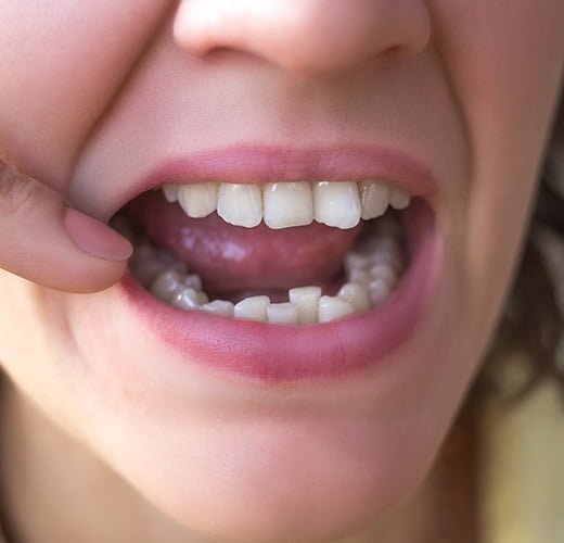 best-Crooked-Tooth-Correction--treatment-in-ahmedabad