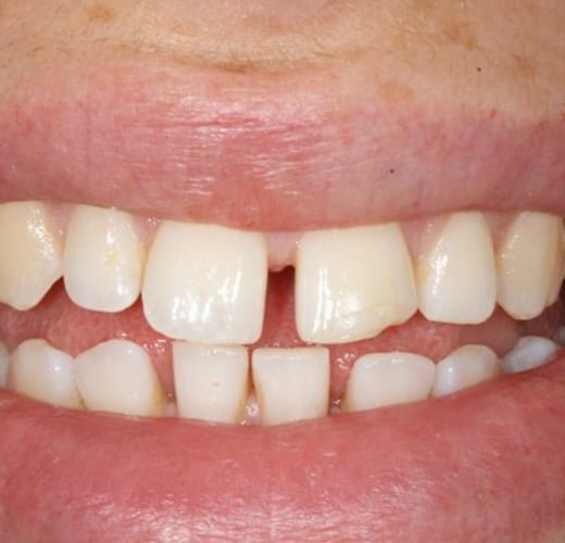 best-Gap-Closure-in-ahmedabad