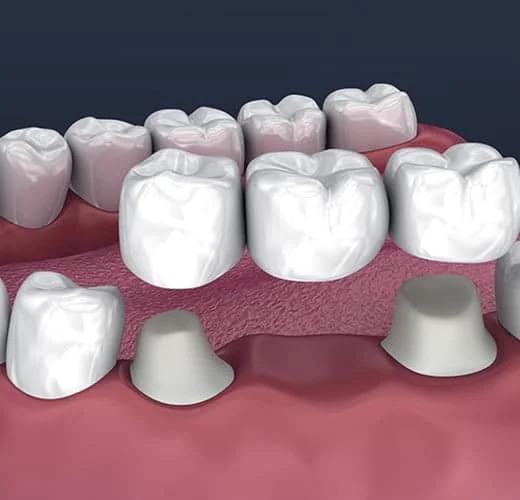 dental Crawn and Bridge treatment dental Crawn and Bridge treatment