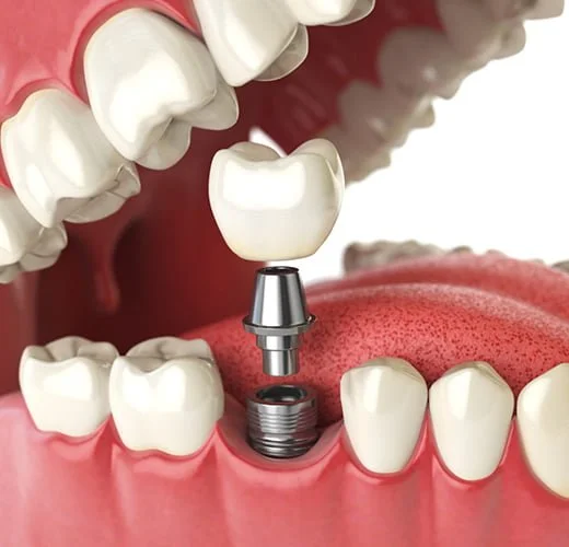 Dental Implants Treatment Ahmedabad Dental Implants Treatment Ahmedabad