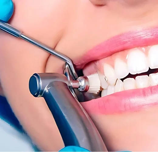Fluoride Treatment in Ahmedabad Fluoride Treatment in Ahmedabad