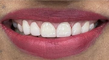 gap-closure-with-laser-lift-After