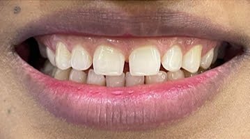 gap-closure-with-laser-lift-Before