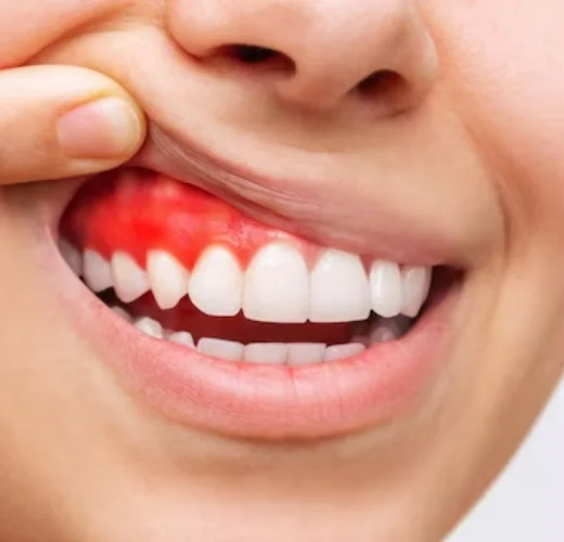 Gum Treatment in Ahmedabad Gum Treatment in Ahmedabad
