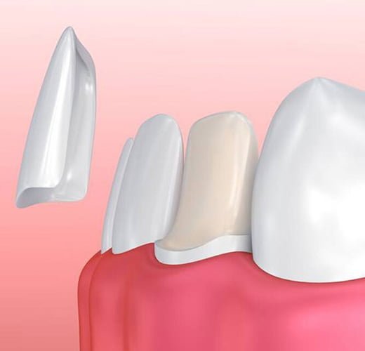 no-prep-prepless-veneers--in-gujarat