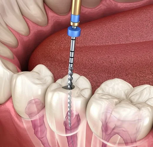 Root Canal Treatment in Ahmedabad Root Canal Treatment in Ahmedabad