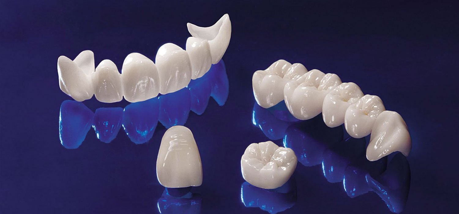 Dental crowns and bridges treatment overview