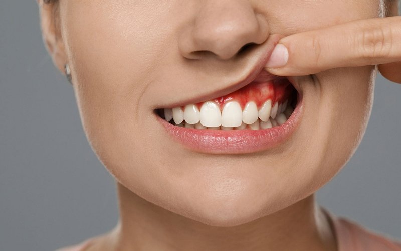 Gums Treatment